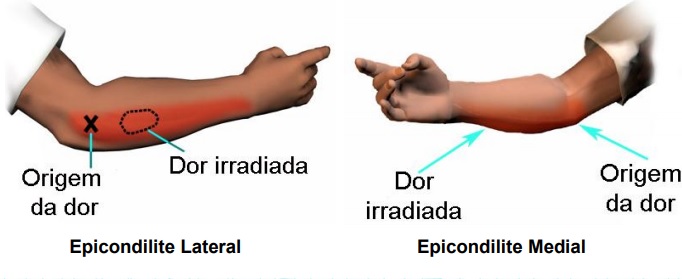 Epicondilite